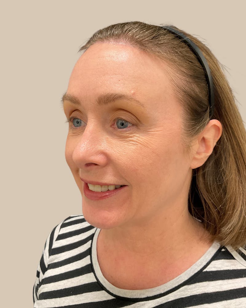 Forehead Reduction Before & After Gallery - Patient 175625 - Image 6