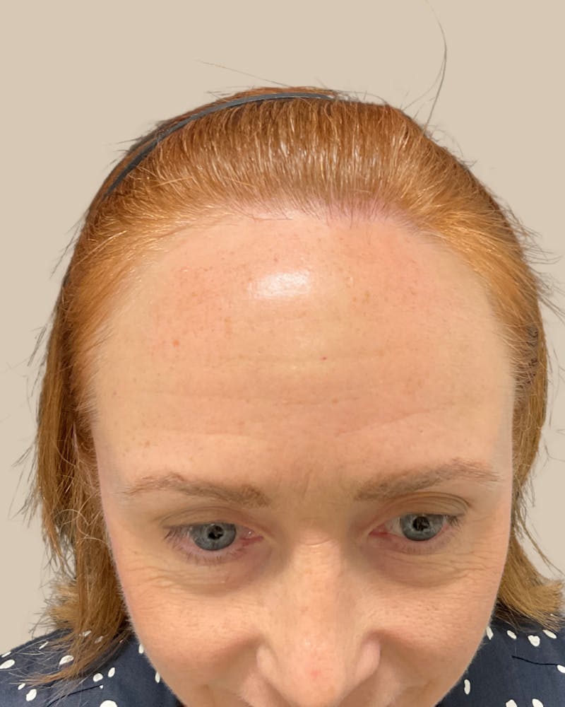 Forehead Reduction Before & After Gallery - Patient 175625 - Image 3