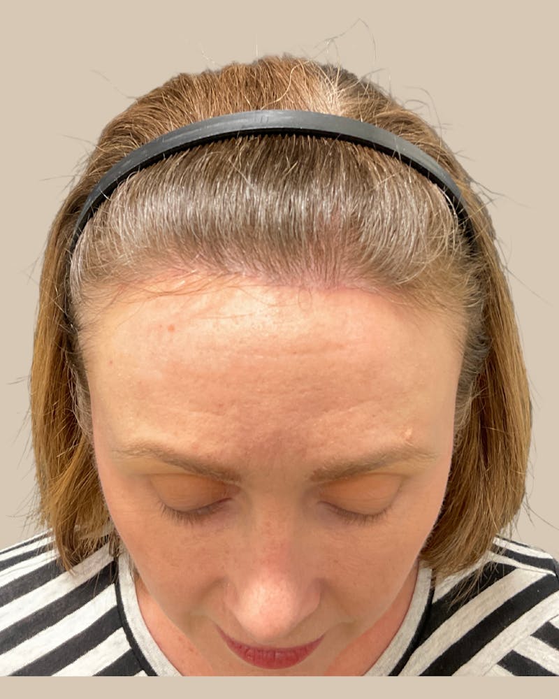 Forehead Reduction Before & After Gallery - Patient 175625 - Image 4