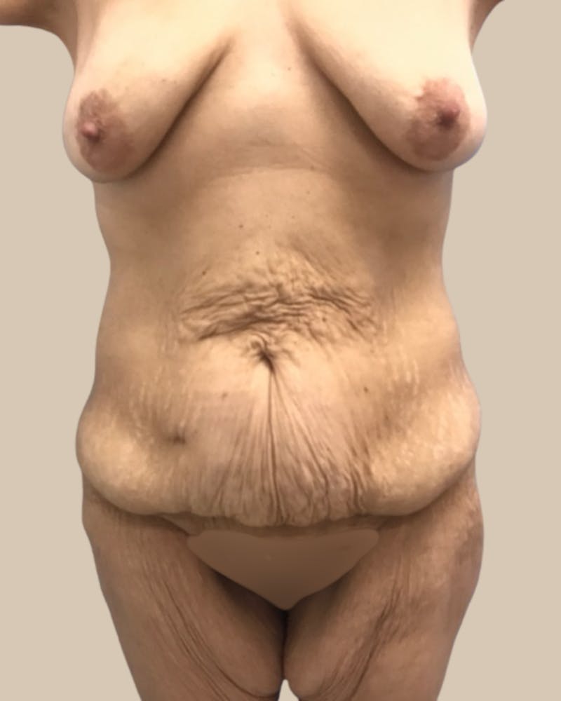 Trunkplasty Before & After Gallery - Patient 714187 - Image 1