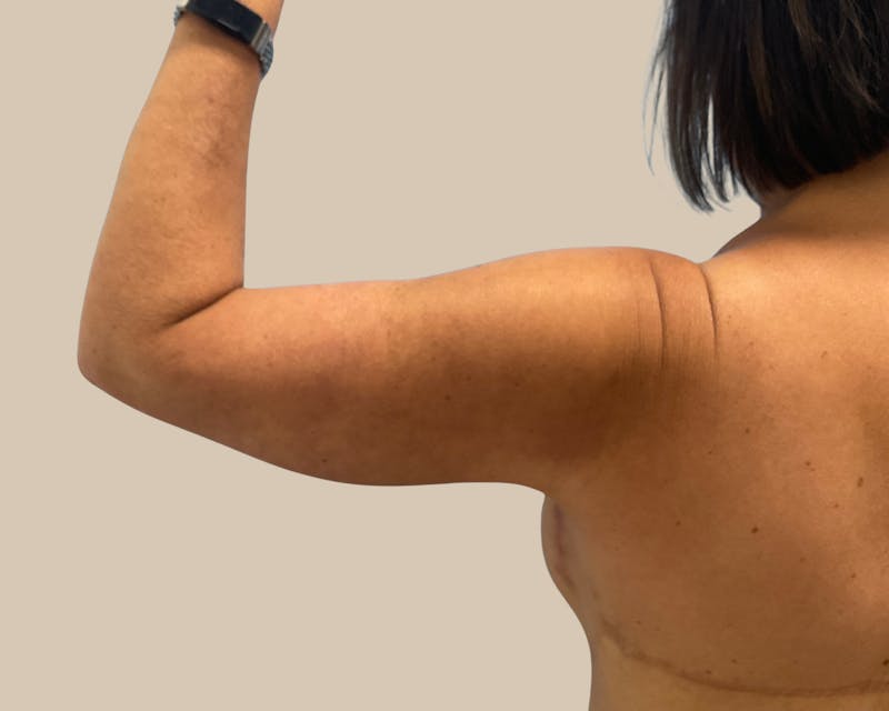 Brachioplasty Before & After Gallery - Patient 262297 - Image 2