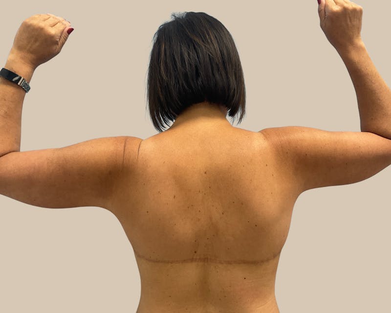 Brachioplasty Before & After Gallery - Patient 262297 - Image 6