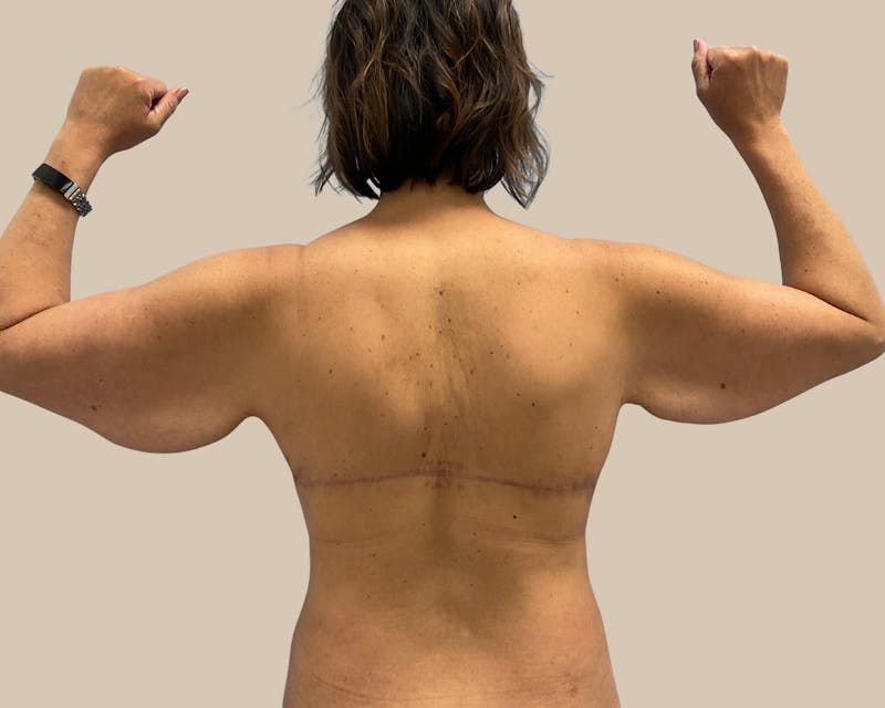 Brachioplasty Before & After Gallery - Patient 262297 - Image 5