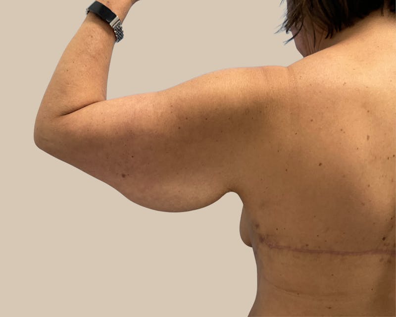 Brachioplasty Before & After Gallery - Patient 262297 - Image 1