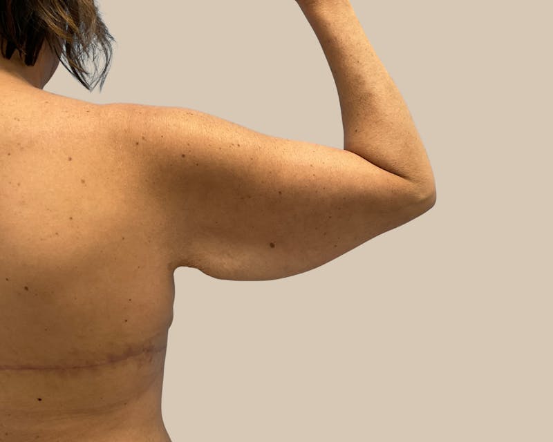 Brachioplasty Before & After Gallery - Patient 262297 - Image 3