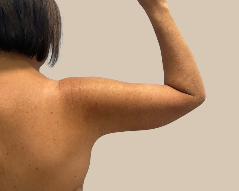 Brachioplasty Before & After Gallery - Patient 262297 - Image 4