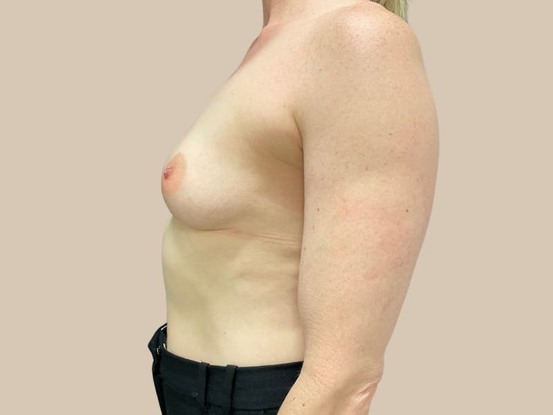 Breast Augmentation Before & After Gallery - Patient 322790 - Image 7