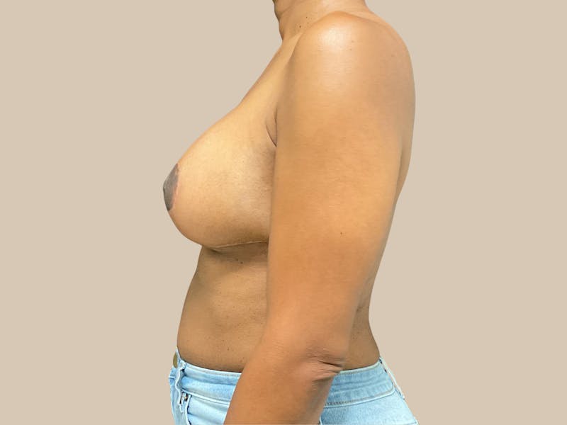 Breast Lift with Augmentation Before & After Gallery - Patient 166000 - Image 6