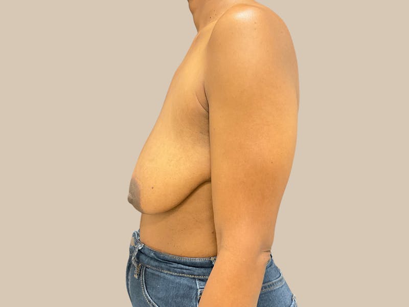 Breast Lift with Augmentation Before & After Gallery - Patient 166000 - Image 5