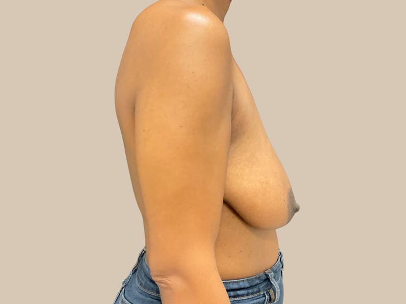 Breast Lift with Augmentation Before & After Gallery - Patient 166000 - Image 9