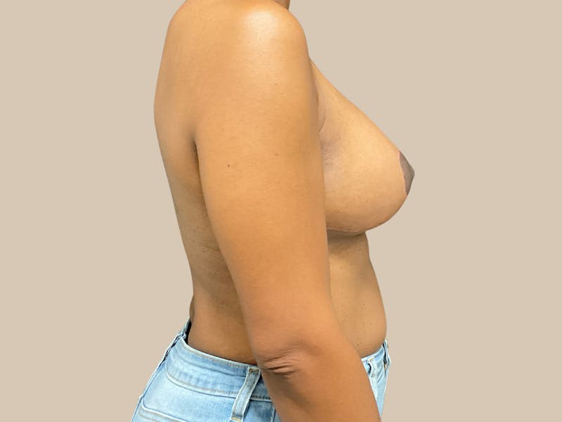 Breast Lift with Augmentation Before & After Gallery - Patient 166000 - Image 10