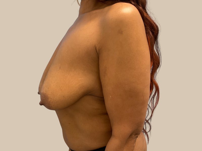 Breast Lift with Augmentation Before & After Gallery - Patient 228766 - Image 5
