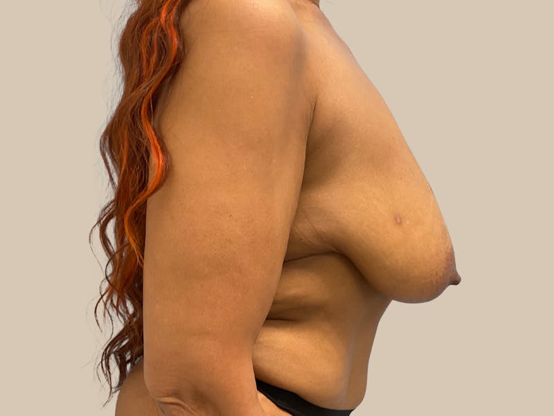 Breast Lift with Augmentation Before & After Gallery - Patient 228766 - Image 9
