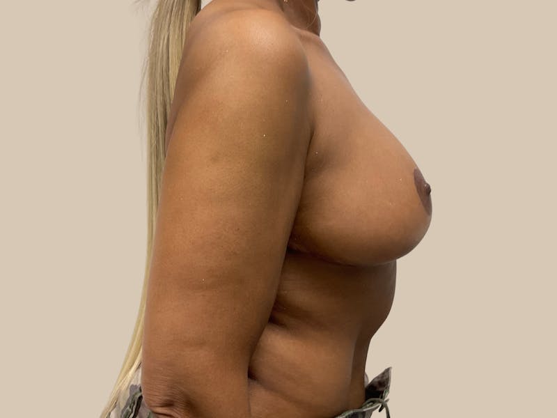 Breast Lift with Augmentation Before & After Gallery - Patient 228766 - Image 10