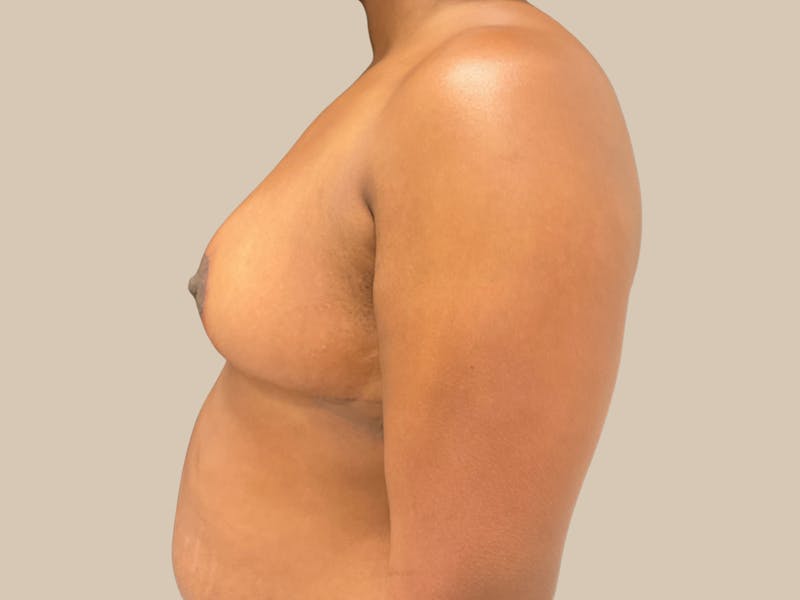 Breast Lift with Augmentation Before & After Gallery - Patient 428245 - Image 9