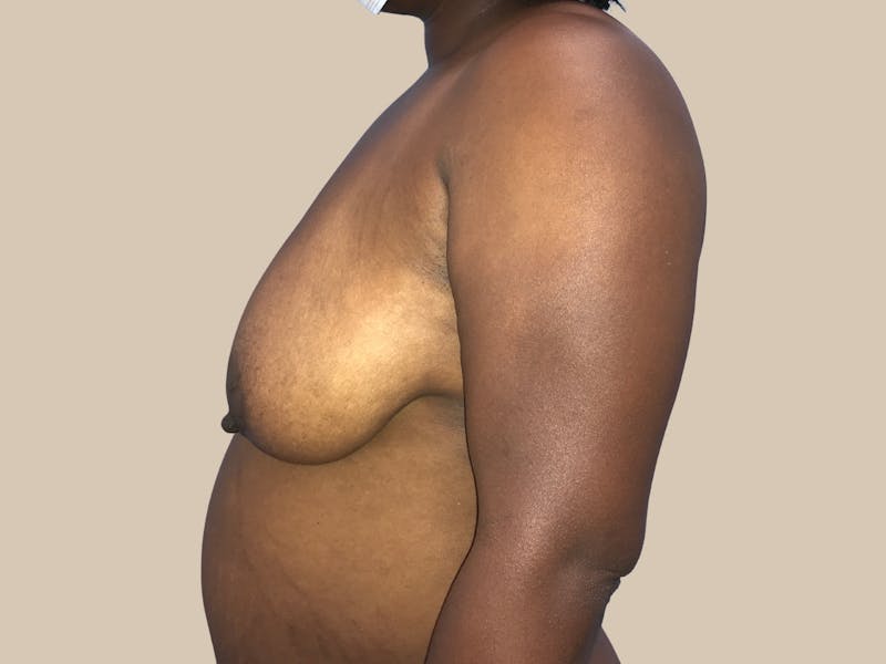 Breast Lift with Augmentation Before & After Gallery - Patient 428245 - Image 10