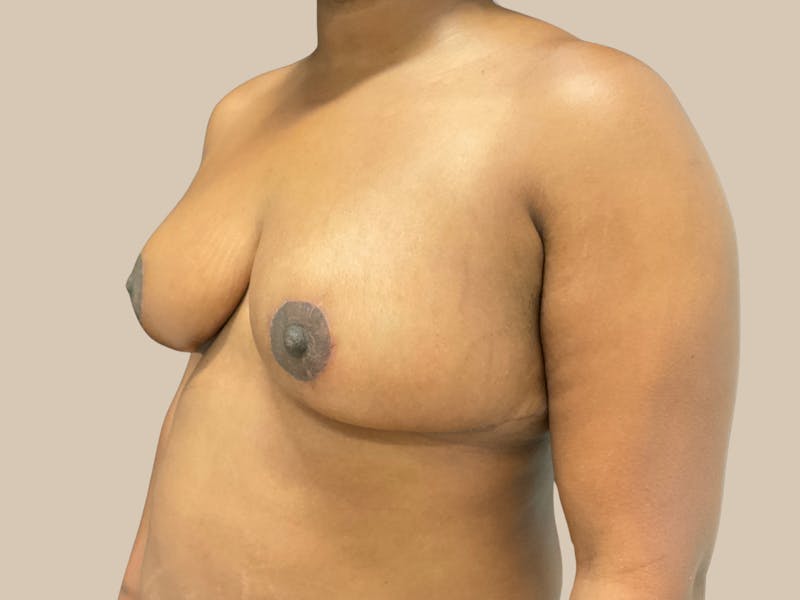 Breast Lift with Augmentation Before & After Gallery - Patient 428245 - Image 8
