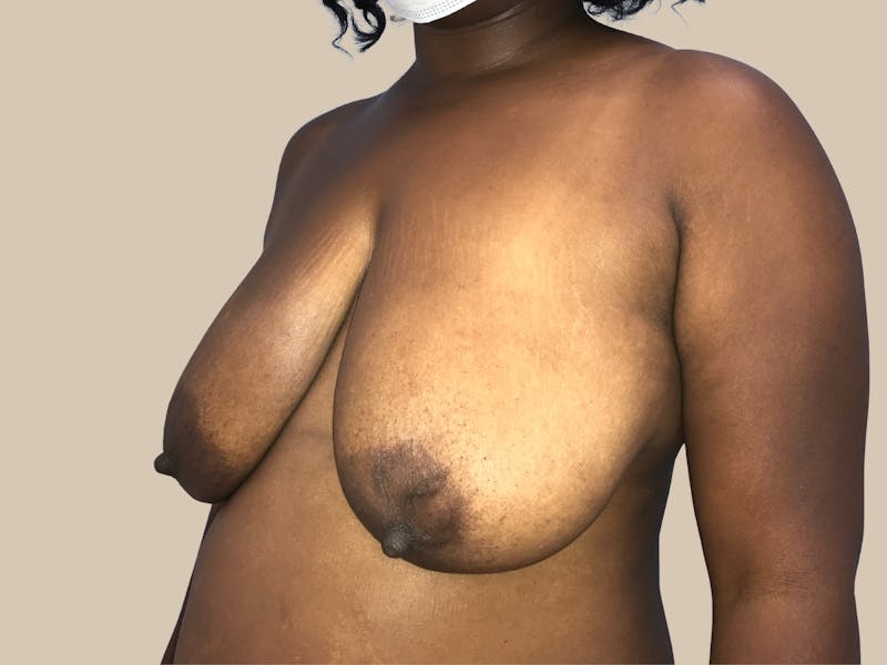 Breast Lift with Augmentation Before & After Gallery - Patient 428245 - Image 7