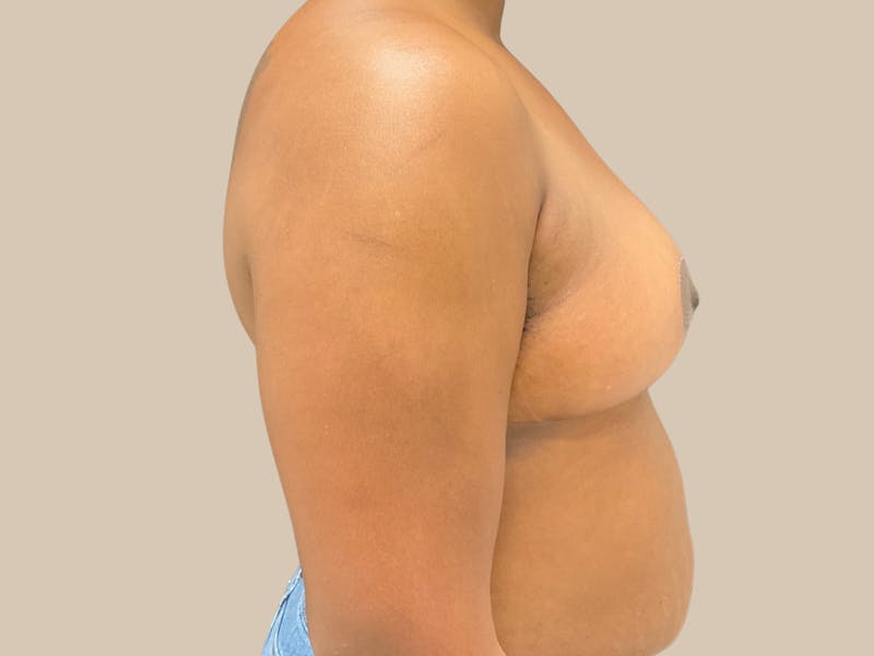 Breast Lift with Augmentation Before & After Gallery - Patient 428245 - Image 6