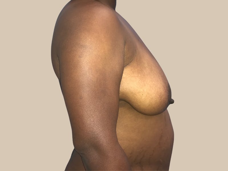 Breast Lift with Augmentation Before & After Gallery - Patient 428245 - Image 5