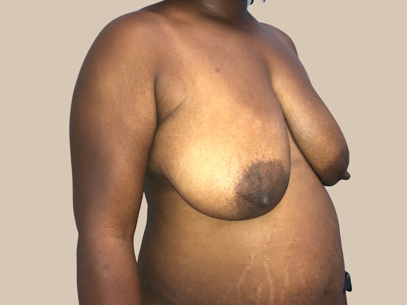 Breast Lift with Augmentation Before & After Gallery - Patient 428245 - Image 3