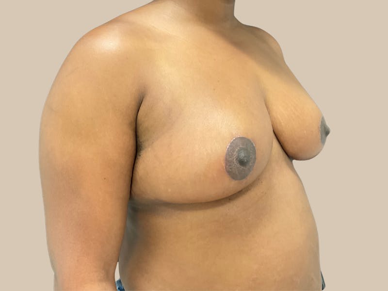 Breast Lift with Augmentation Before & After Gallery - Patient 428245 - Image 4