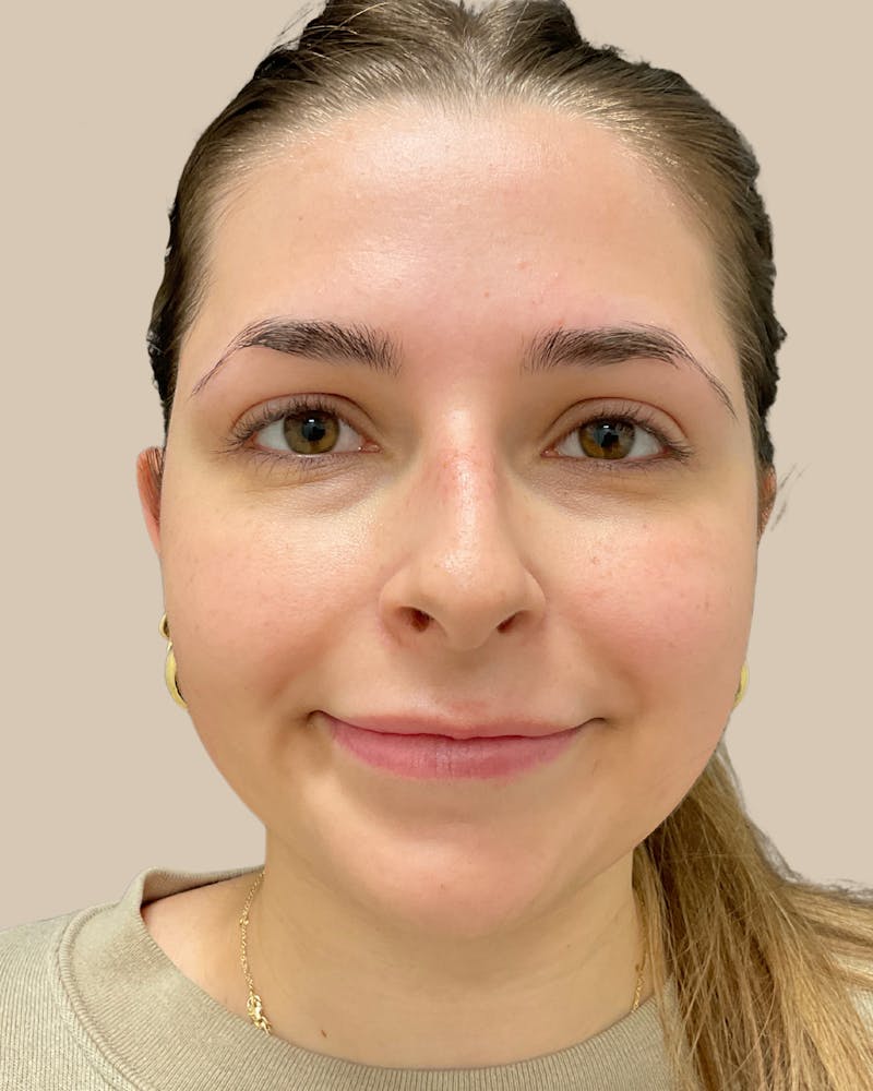 Rhinoplasty Before & After Gallery - Patient 111232 - Image 3