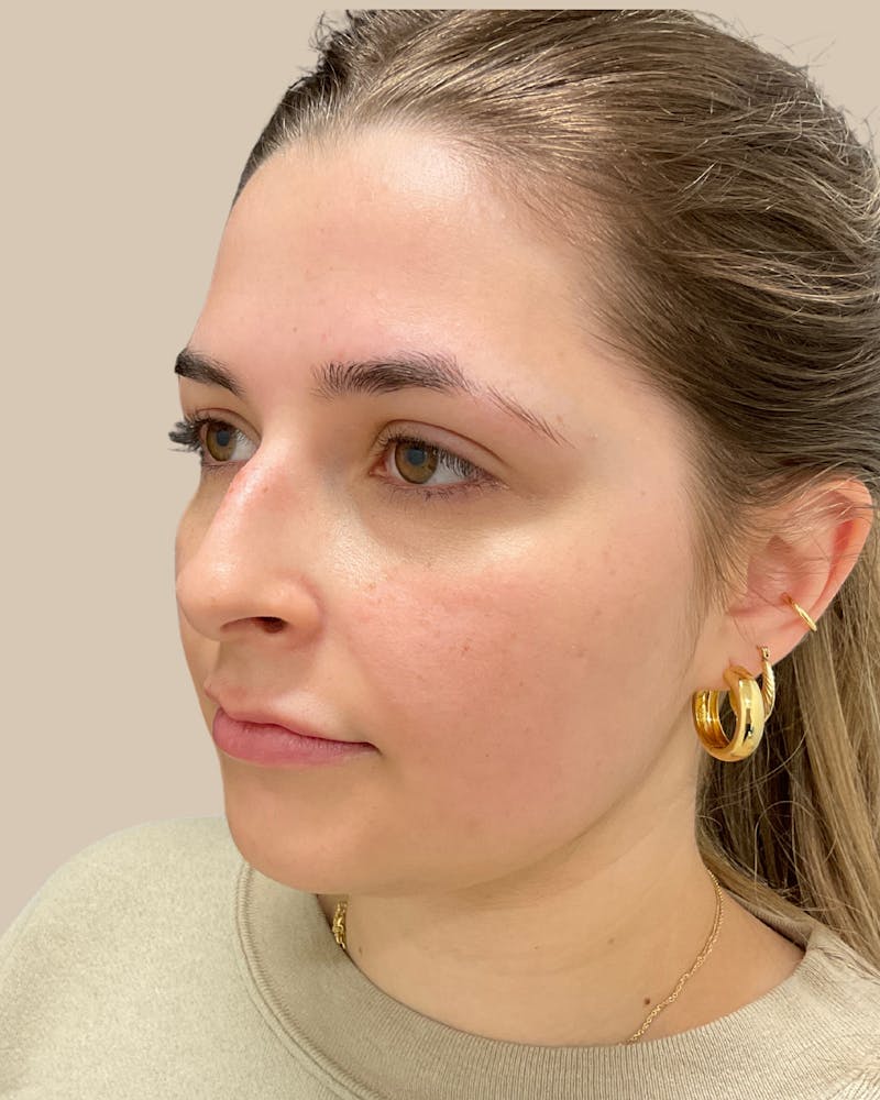 Rhinoplasty Before & After Gallery - Patient 111232 - Image 7