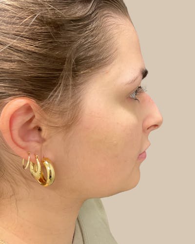 Rhinoplasty Before & After Gallery - Patient 111232 - Image 1