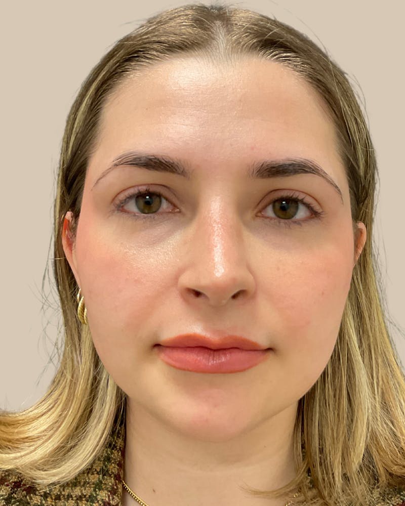 Rhinoplasty Before & After Gallery - Patient 111232 - Image 4