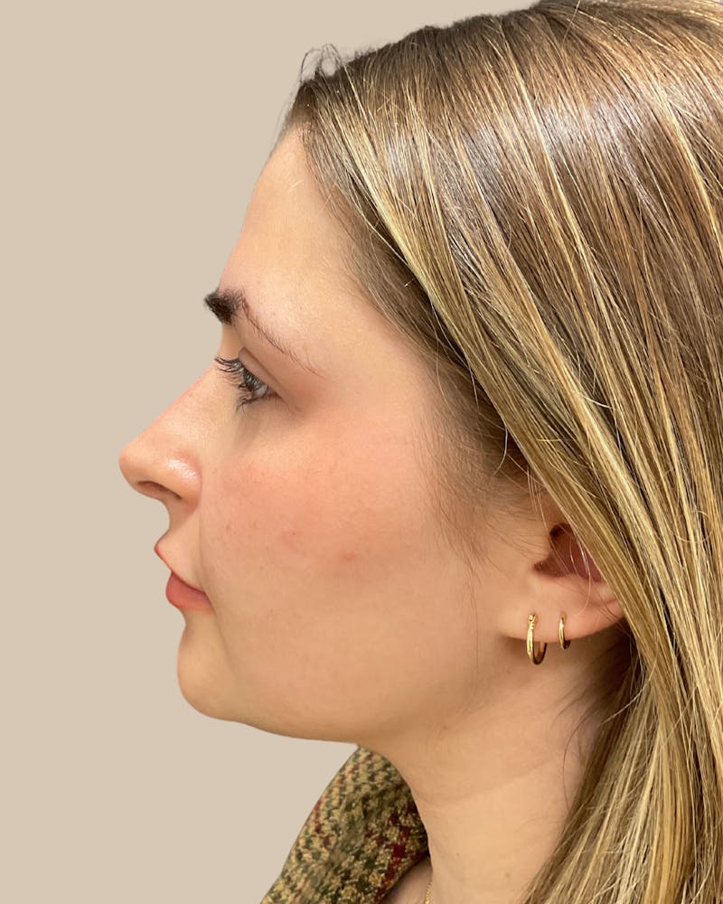 Rhinoplasty Before & After Gallery - Patient 111232 - Image 10