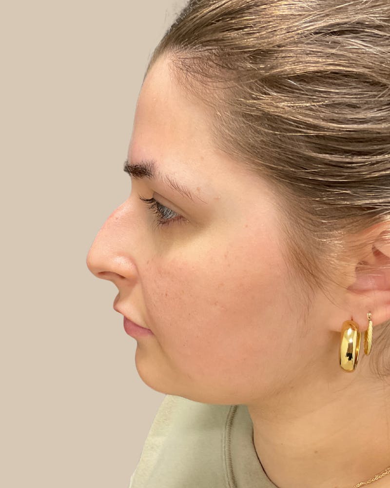 Rhinoplasty Before & After Gallery - Patient 111232 - Image 9
