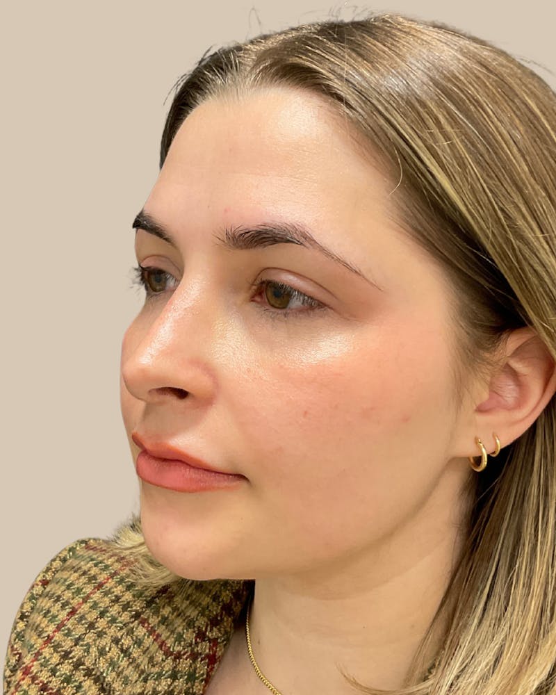 Rhinoplasty Before & After Gallery - Patient 111232 - Image 8