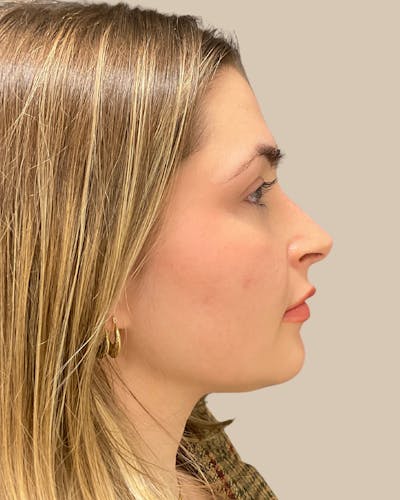 Rhinoplasty Before & After Gallery - Patient 111232 - Image 2