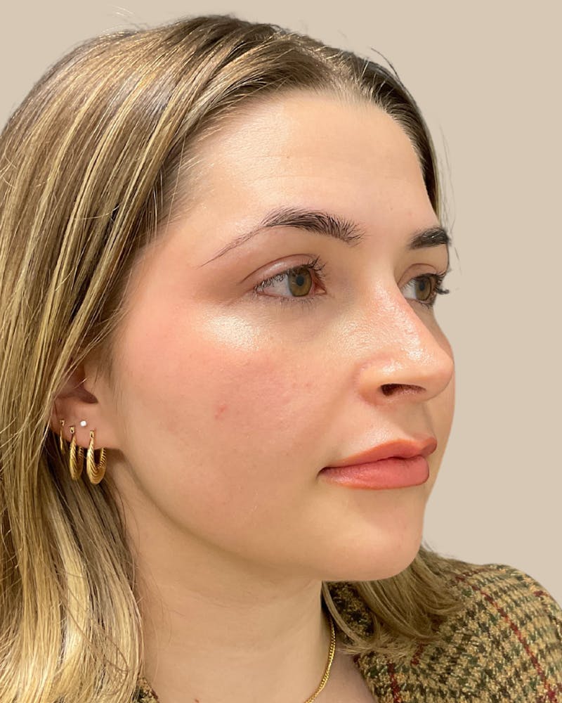 Rhinoplasty Before & After Gallery - Patient 111232 - Image 6