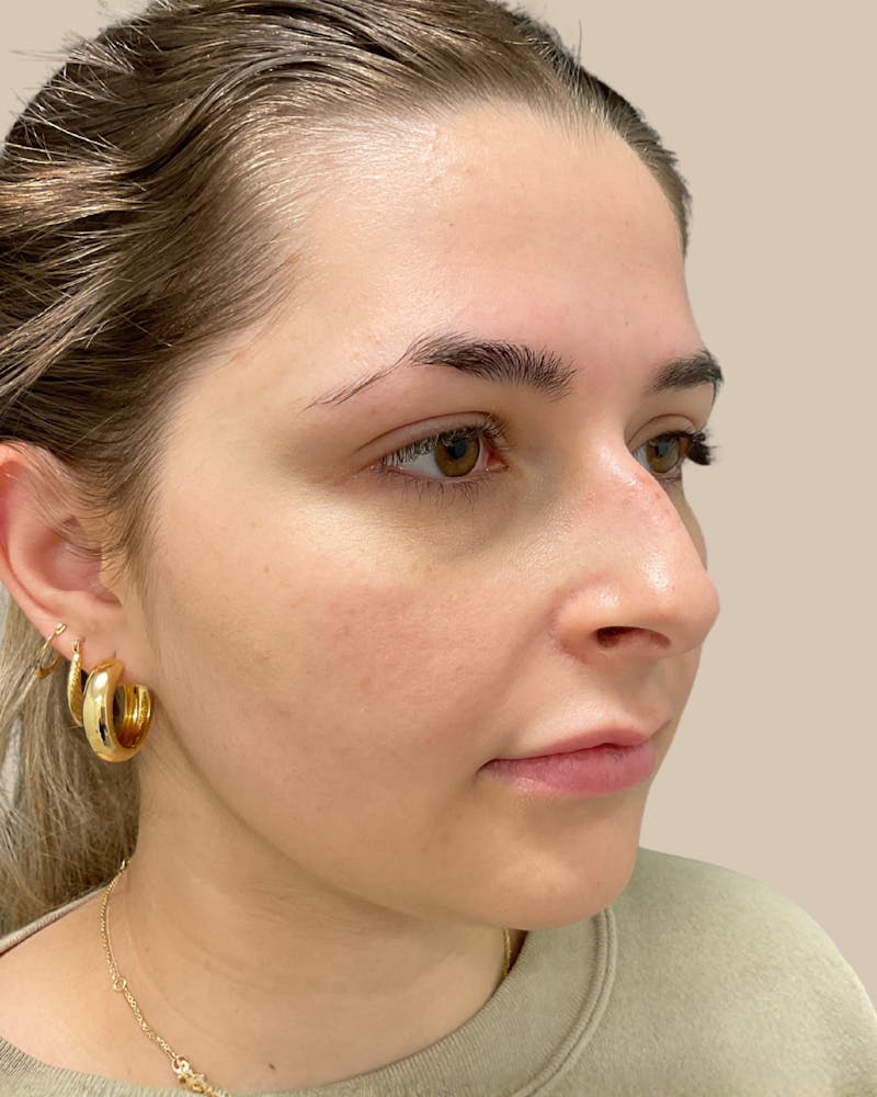 Rhinoplasty Before & After Gallery - Patient 111232 - Image 5