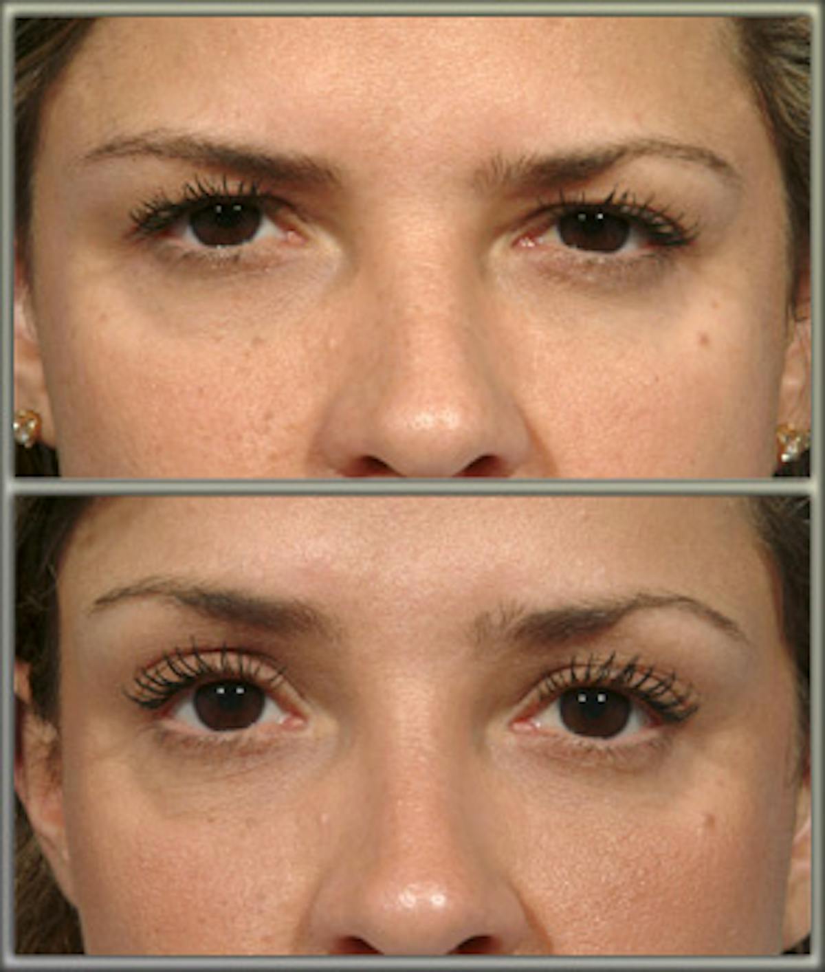 BOTOX® Before & After Gallery - Patient 121377333 - Image 1