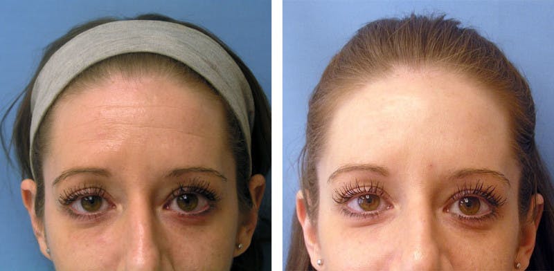 BOTOX® Before & After Gallery - Patient 121377352 - Image 1