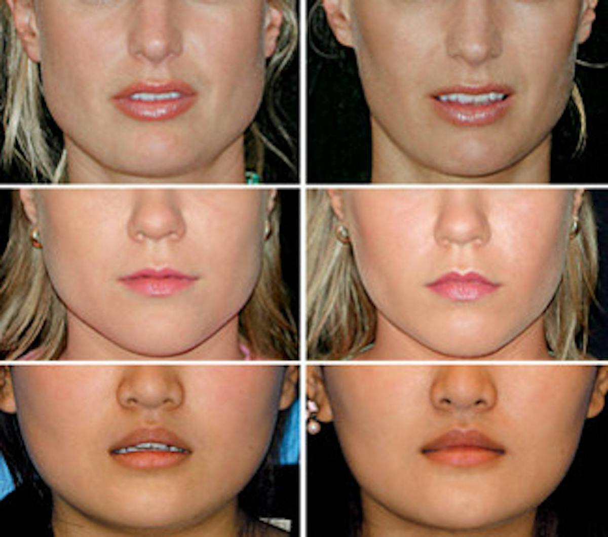 BOTOX® Before & After Gallery - Patient 121377353 - Image 1