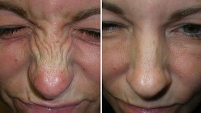 BOTOX® Before & After Gallery - Patient 121377357 - Image 1