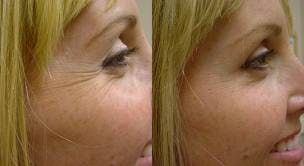 BOTOX® Before & After Gallery - Patient 121377358 - Image 1