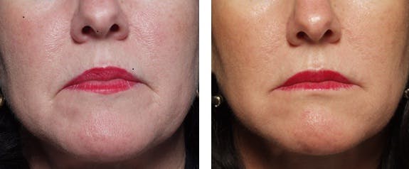 BOTOX® Before & After Gallery - Patient 121377360 - Image 1