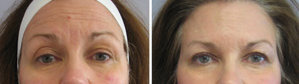 BOTOX® Before & After Gallery - Patient 121377362 - Image 1