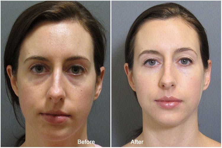 Dermal Fillers Before & After Gallery - Patient 121377419 - Image 1