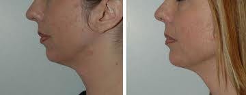Dermal Fillers Before & After Gallery - Patient 121377420 - Image 1
