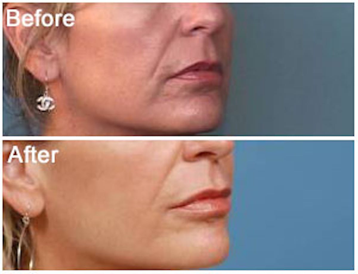 Dermal Fillers Before & After Gallery - Patient 121377421 - Image 1