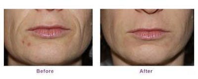 Dermal Fillers Before & After Gallery - Patient 121377422 - Image 1
