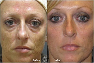 Dermal Fillers Before & After Gallery - Patient 121377424 - Image 1