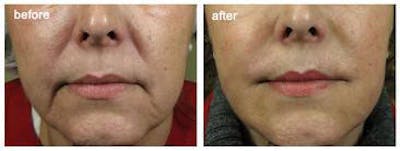 Dermal Fillers Before & After Gallery - Patient 121377425 - Image 1