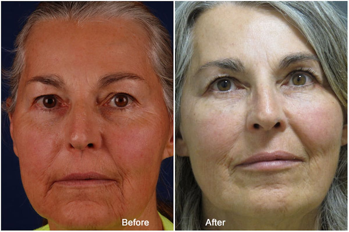 Dermal Fillers Before & After Gallery - Patient 121377427 - Image 1